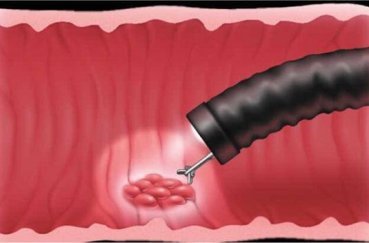 Как легче перенести ФГДС и пройти процедуру без проблем: учимся глотать кишку так, чтобы проверить желудок просто, больно ли делать и как пережить введение трубки?