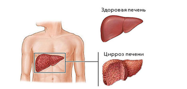 Симптомы цирроза печени у мужчин алкоголиков и лечение болезни