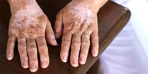 Коричневые пятна на ногтях рук и ног: провоцирующие факторы и причины пигментации, методы диагностики и лечения, длительность терапии, прогноз и меры профилактики