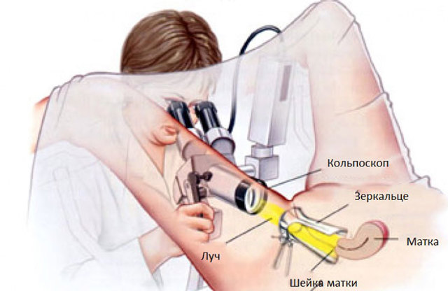 Больно ли делать кольпоскопию или нет: отзывы, техника проведения