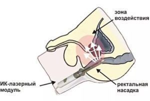 Лазерная терапия при простатите и аденоме простаты