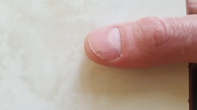Черные полоски на ногтях рук: причины, что это значит, как лечить