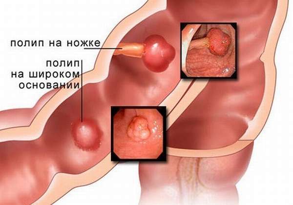 Полипы в поджелудочной железе: причины и лечение