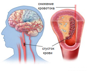 Инсульт - причины, симптомы, диагностика и лечение