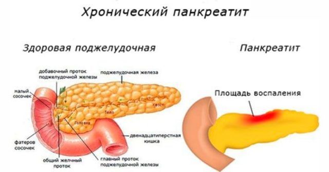 Что можно есть при панкреатите - список продуктов питания