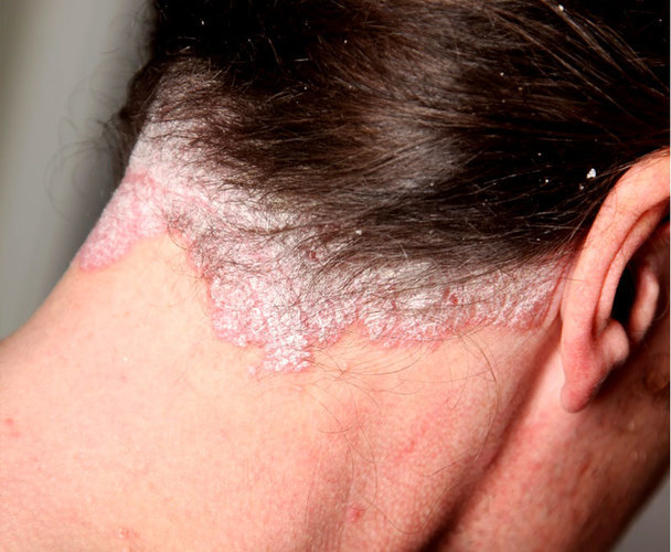 Сухая себорея кожи головы и лица - симптомы и лечение шампунем, народными средствами и мазями