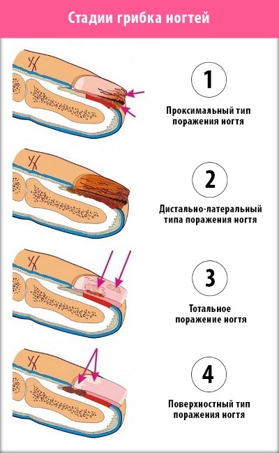 Укрепление ногтей гелем в домашних условиях (пошагово)