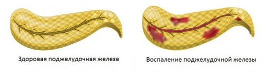Роль поджелудочной железы в организме человека: симптомы заболеваний и лечение