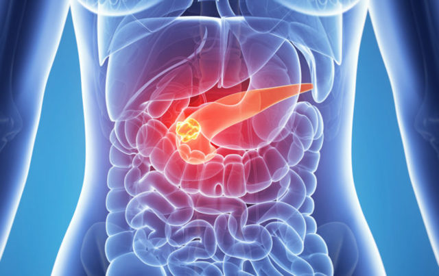 Смерть от панкреатита – вероятность развития летального исхода при заболеваниях ЖКТ