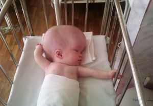 Менингит у новорожденных детей, симптомы и последствия