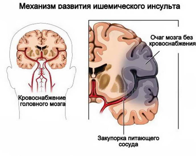 Гипоксия мозга: симптомы, лечение у взрослых препаратами, нехватка O2