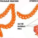 Внутренний и наружный геморрой: чем отличается лечение