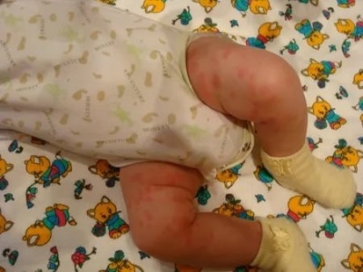 Сыпь на попе у ребенка — симптом пеленочного дерматита