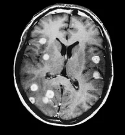 Метастазы в головном мозге: продолжительность жизни, симптомы, лучевая терапия при метастазах мозга