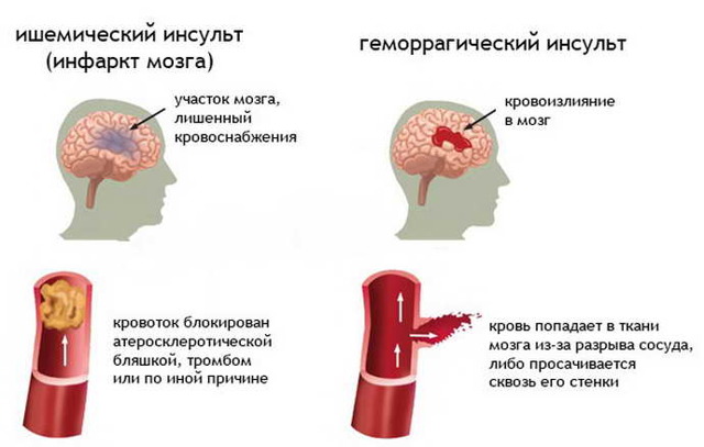 Нарушение мозгового кровообращения - причины, признаки и симптомы