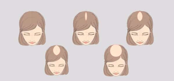 Причины выпадения волос: почему выпадают волосы на голове?