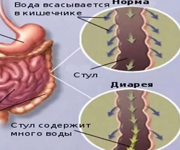 Понос (диарея) у взрослого: причины и быстрые способы лечения