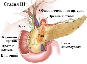 Рак поджелудочной железы 4 стадия: сколько живут при онкологии поджелудочной железы 4 степени