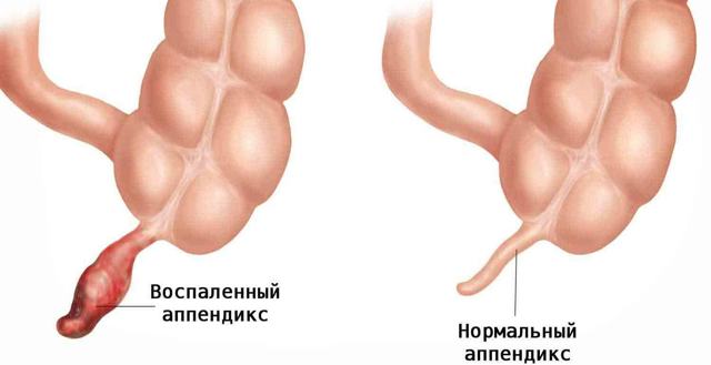 Когда можно пить алкоголь после удаления аппендицита