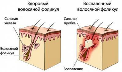 Почему появляются прыщи на голове в волосах?