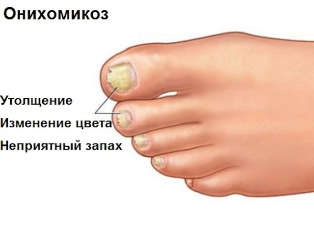Грибок ногтей на руках (онихомикоз): симптомы, лечение. Фото