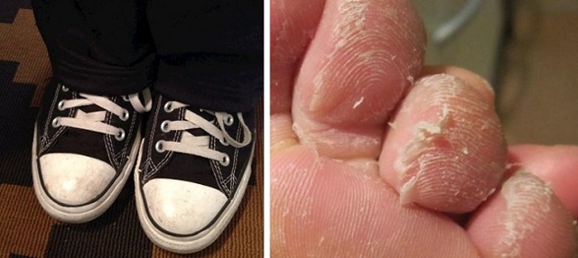 Почему шелушится и облазит кожа между пальцами ног