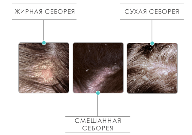Cеборея кожи головы лечение в домашних условиях, фото