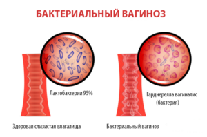 Водянистые выделения при беременности