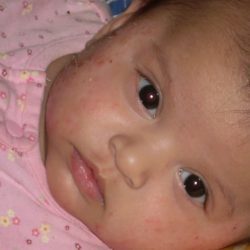Атопический дерматит у детей: фото, симптомы и лечение