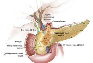 Диффузные изменения поджелудочной железы лечение