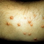 Пятна на коже при заболеваниях поджелудочной железы: кожные проявления, красные точки, сыпь, высыпания