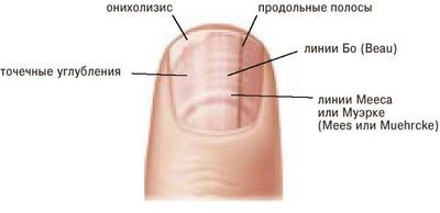 Полоски на ногтях их причины и лечение