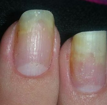 Отслоение ногтя на большом пальце ноги: лечение и профилактика