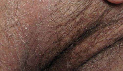 Грибок в паху у мужчин: чем лечить, фото, симптомы