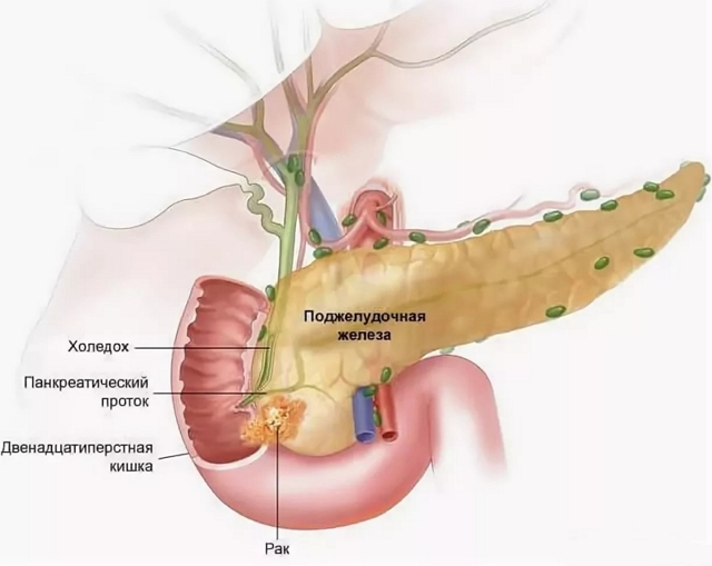 Рак поджелудочной железы - причины, симптомы, диагностика и лечение, прогноз