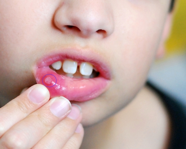 Антибиотики при стоматите у взрослых и детей: лечение