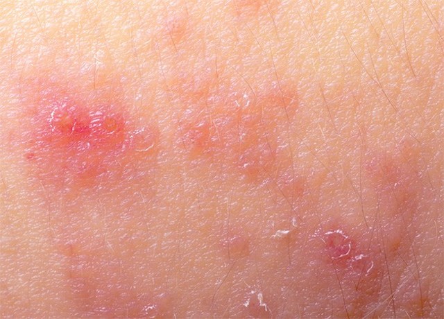Атопический дерматит на руках у взрослого и ребенка (фото): причины и лечение