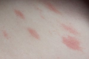 Красные пятна на коже у взрослых и детей - виды высыпаний и их фото, аллергия с зудом и без