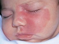 Пятно на коже у ребенка (34 фото): белые, кофейные и шершавые красные, светлые пятна у грудничков и новорожденных, белые после загара