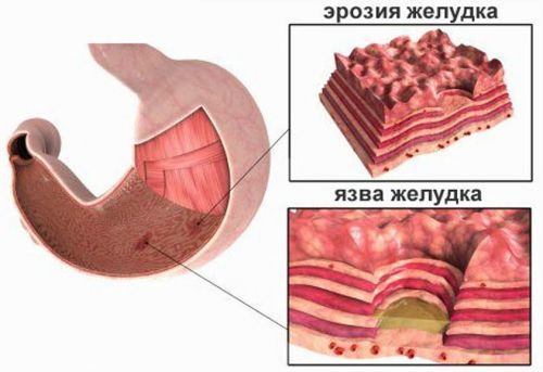 Как лечить бактериальный гастрит