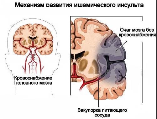 Ишемический инсульт головного мозга: лечение, восстановление и возможные последствия