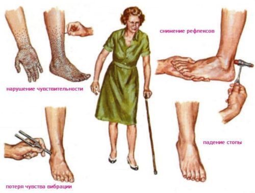 Полинейропатия конечностей – что это, симптомы, лечение