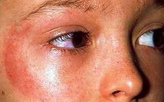 Солнечный дерматит - причины, симптомы и лечение (фото) 2020