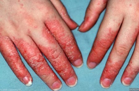 Эксфолиативный дерматит (болезнь Риттера синдром ошпаренной кожи) – что это такое?