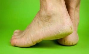 Отслаивается ноготь на большом пальце ноги - возможные причины, медикаментозное и хирургическое лечение