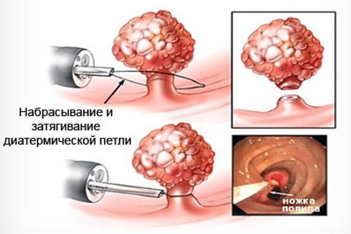 Боль в прямой кишке болезни симптомы диагностика лечение профилактика рекомендации