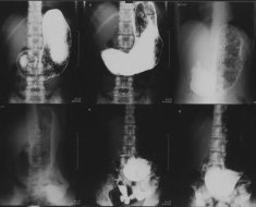 Рентген желудка с барием: что показывает, подготовка, последствия