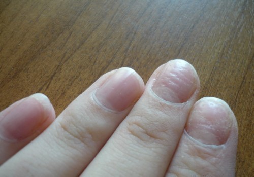 Волнистые ногти на руках причины лечение