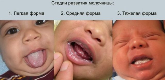 Молочница у новорожденных младенцев и грудничков во рту на языке: симптомы, лечение, эффективные средства, как выглядит