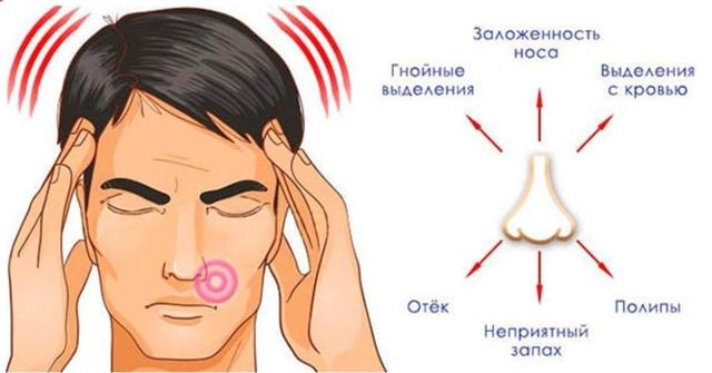 Головная боль при гайморите: симптомы как болит голова у взрослых